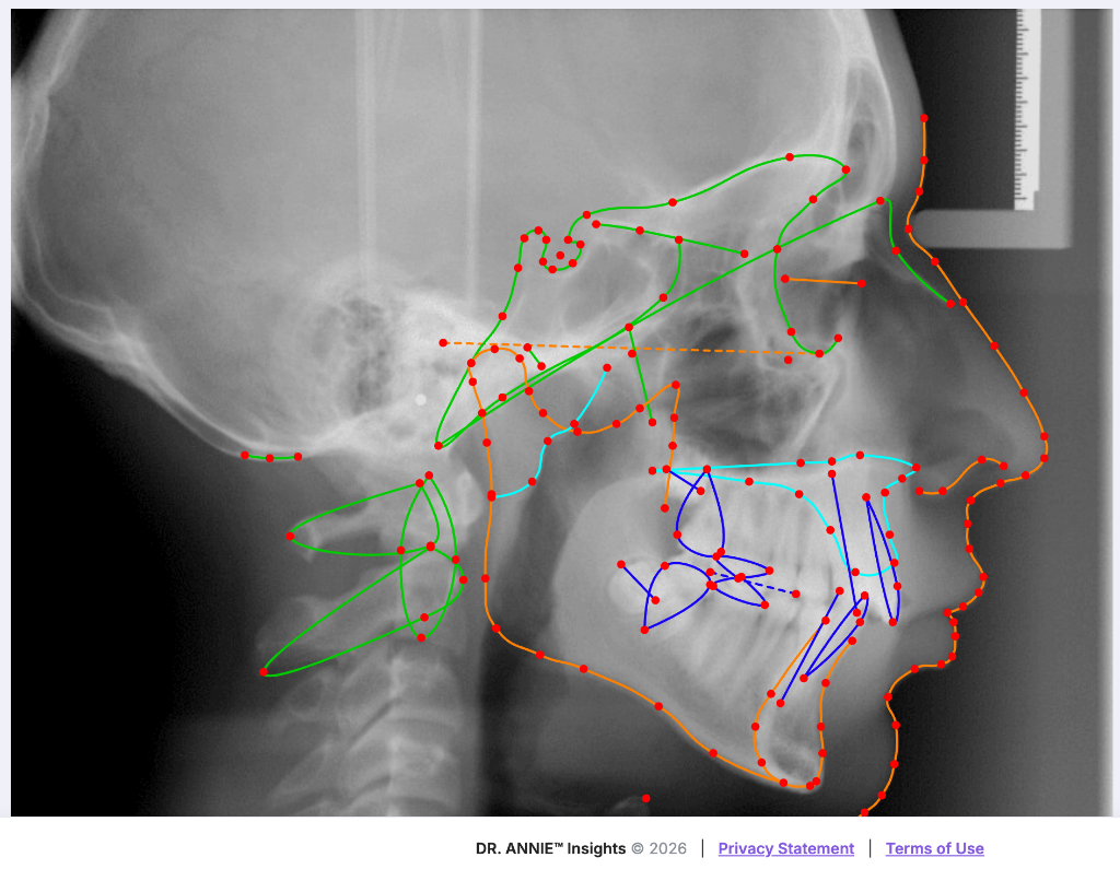 DR. ANNIE™ Insights AI dashboard — cephalometric X-ray digitization with landmark detection and orthodontic analysis