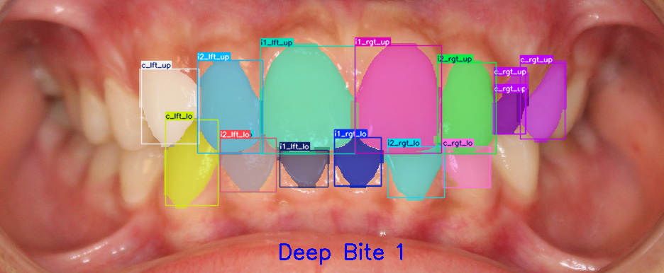 Intraoral dental photograph with AI segmentation — tooth boundaries, decay, and restorations identified by DR. ANNIE™ Insights