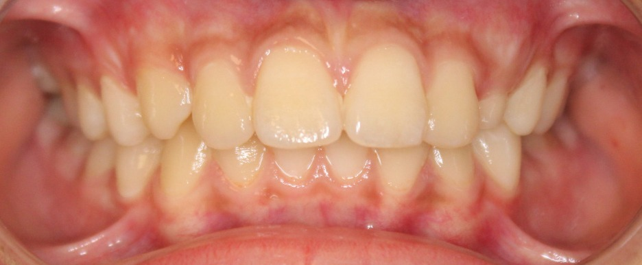 Intraoral dental photograph before AI analysis — clinical photo of patient teeth