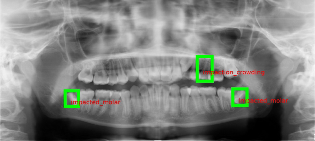 Panoramic dental X-ray after AI analysis — cavities, bone loss, and calculus detected and highlighted by DR. ANNIE™ Insights