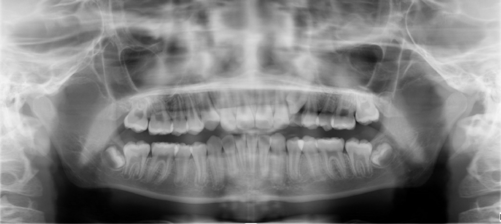 Panoramic dental X-ray before AI analysis — raw radiograph showing full mouth view